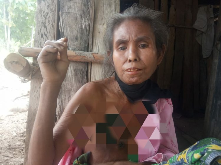 Sumina Asbanu saat menunjukkan kanker payudara yang dideritanya (Foto: Joe Kikhau/BentaraNet)