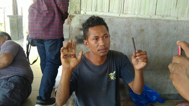 Mikael Ariyanto, warga Desa Baomekot, Kecamatan Hewokloang, Kabupaten Sikka menunjukan tangannya yang melepuh akibat memegang besi panas saat mengikuti ritual adat / Foto : BentaraNet (Arnold Siku)