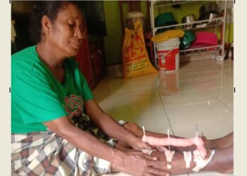 Sudah Sebulan Pen Kaki Belum Dilepas, Fatima Minta Perhatian Pemda Lembata