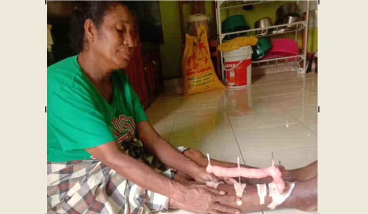 Fatima Buta, penyintas asal Desa Tanjung Batu, Kecamatan Ile Ape dengan pen yang masih terpasang di kaki saat berada di rumah salah satu relawan di Kupang / Foto : Istimewa